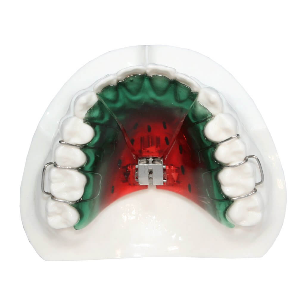 Palate Expander